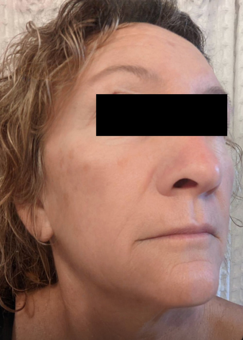 Patient 1 week after Microneedling treatment.