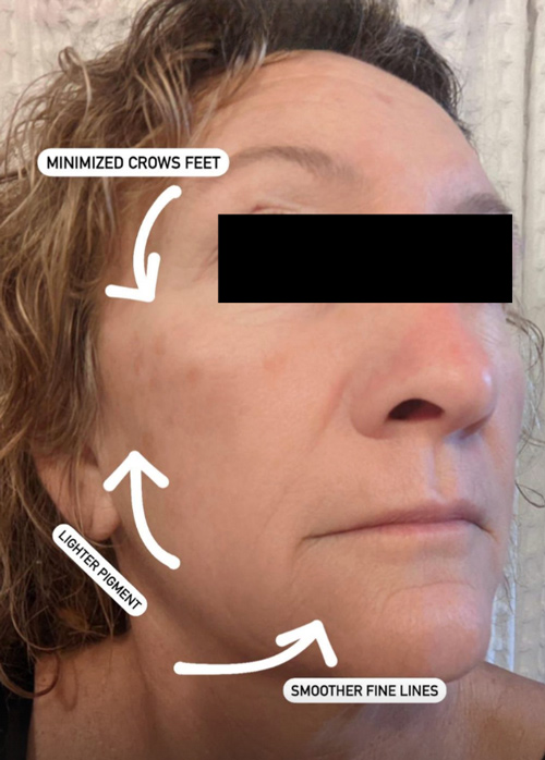 Patient 1 week after Microneedling treatment.