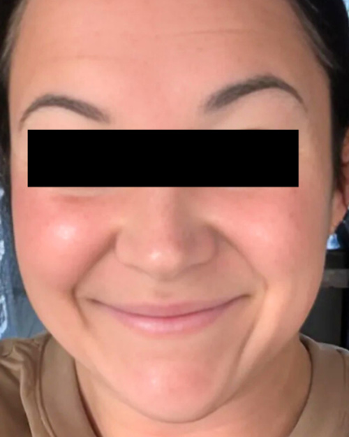 Patient 18 hours after Microneedling treatment.