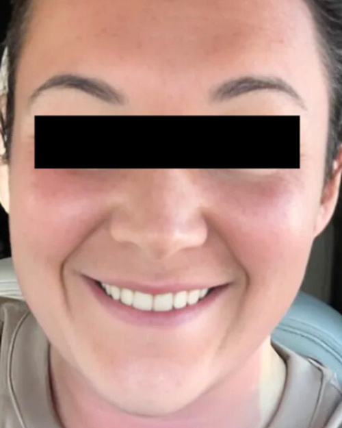 Patient 45 minutes after Microneedling treatment.