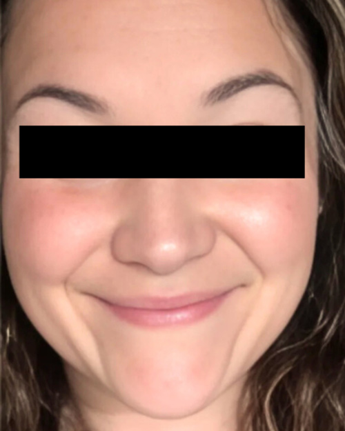Patient 48 hours after Microneedling treatment.