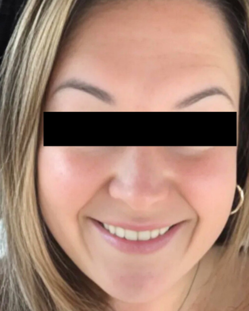 Patient 1 week after Microneedling treatment.