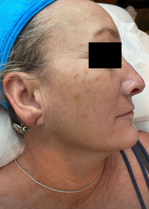 Patient before Microneedling treatment.