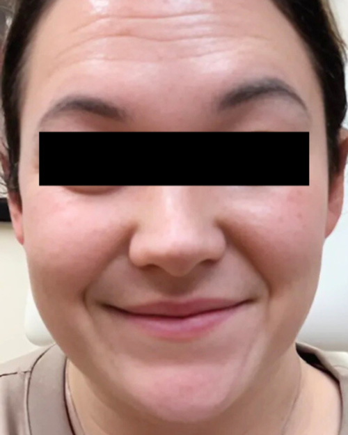 Patient before Microneedling treatment.