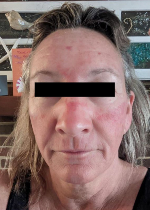 Patient 1 day after Microneedling treatment.