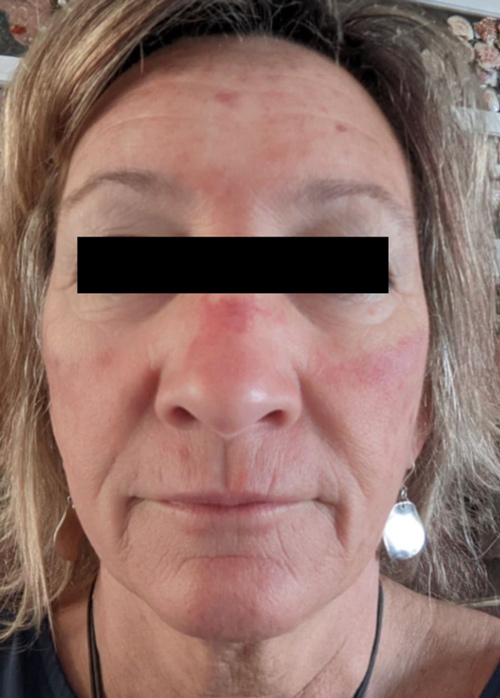 Patient 2 days after Microneedling treatment.