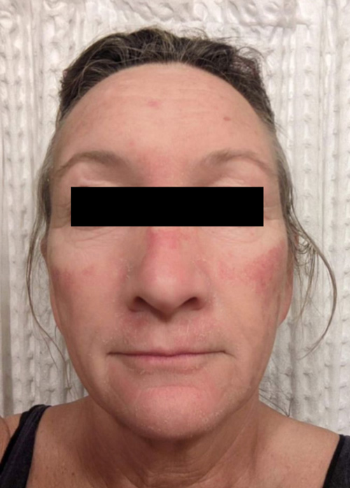 Patient 3 days after Microneedling treatment.