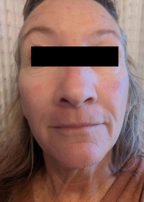 Patient 5 days after Microneedling treatment.