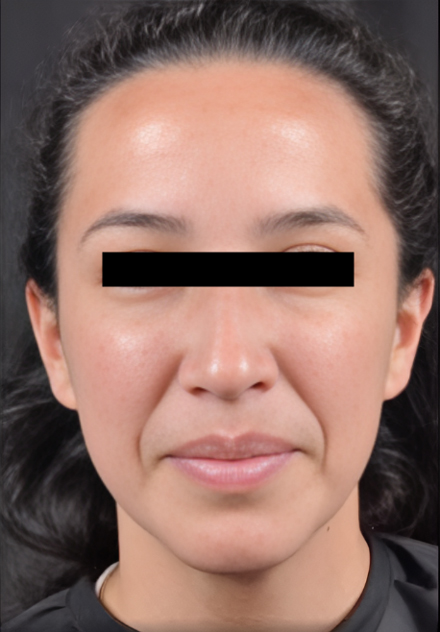 Patient's face after Botox Cosmetic treatment