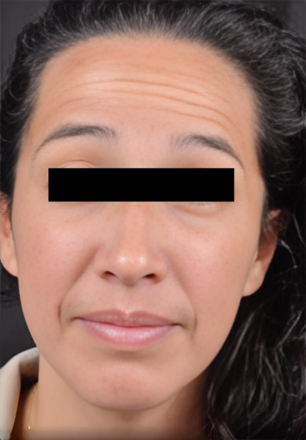 Patient's face before Botox Cosmetic treatment