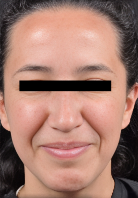 Patient's face after Botox Cosmetic treatment