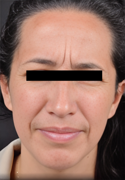 Patient's face before Botox Cosmetic treatment