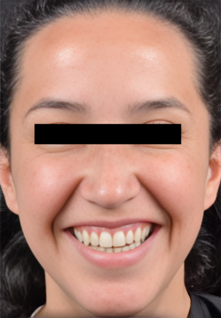Patient's face after Botox Cosmetic treatment