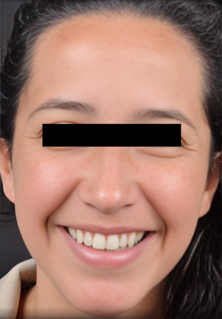 Patient's face before Botox Cosmetic treatment
