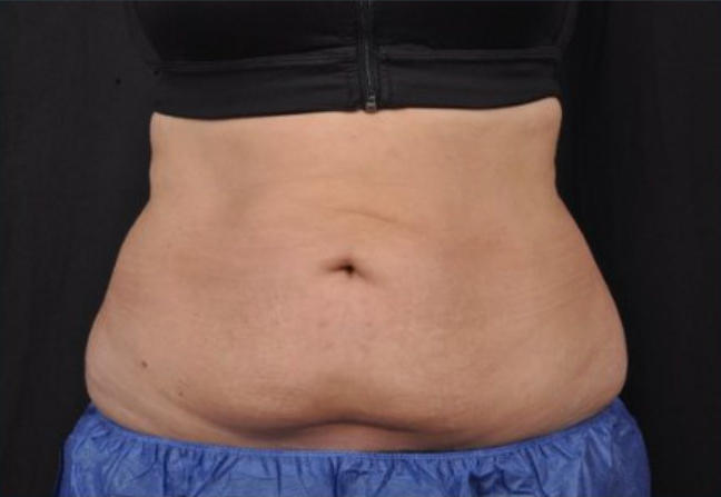 Front view of a patient's mid section 4 weeks after Coolsculpting Elite treatment.