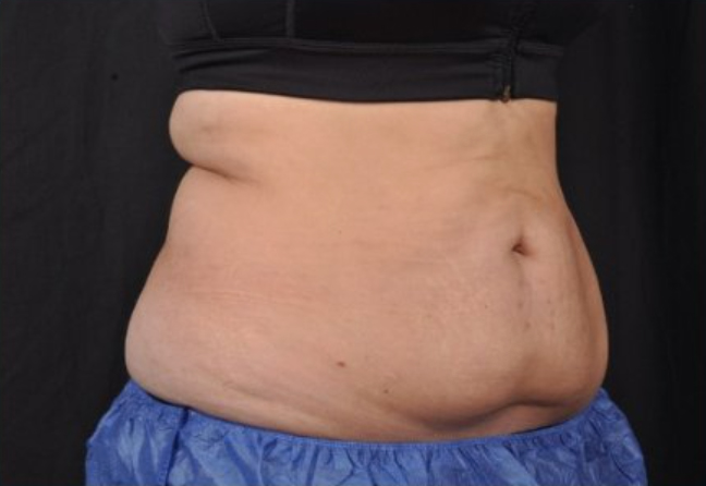 Oblique view of a patient's mid section 4 weeks after Coolsculpting Elite treatment.