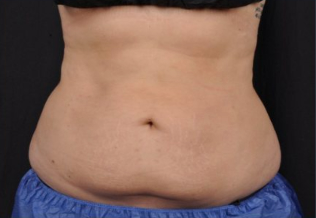 Front view of a patient's mid section 8 weeks after Coolsculpting Elite treatment.