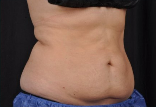 Oblique view of a patient's mid section 8 weeks after Coolsculpting Elite treatment.