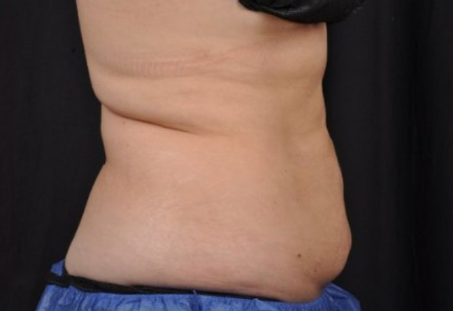 Side view of a patient's mid section 8 weeks after Coolsculpting Elite treatment.