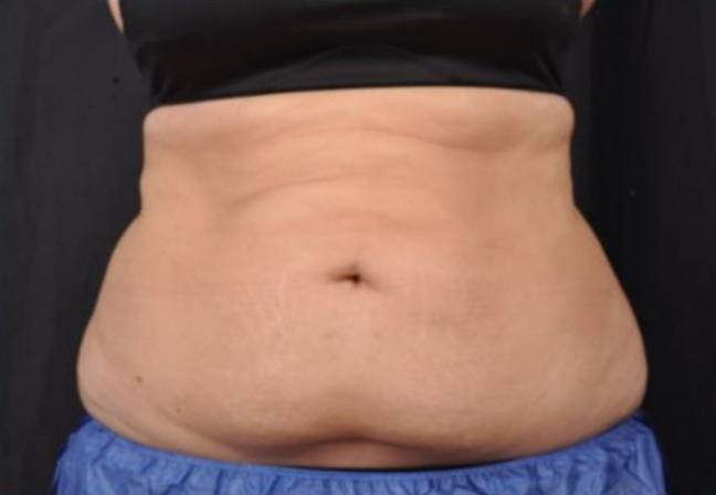 Front view of a patient's mid section before Coolsculpting Elite treatment.
