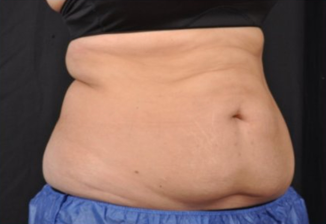 Oblique view of a patient's mid section before Coolsculpting Elite treatment.