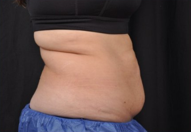 Side view of a patient's mid section before Coolsculpting Elite treatment.
