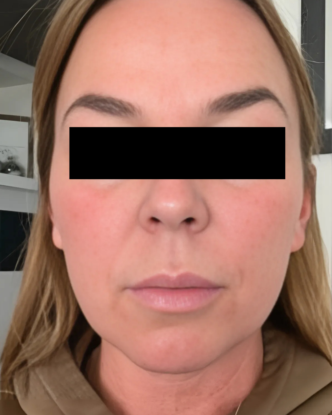 Microneedling Post 24 Hours