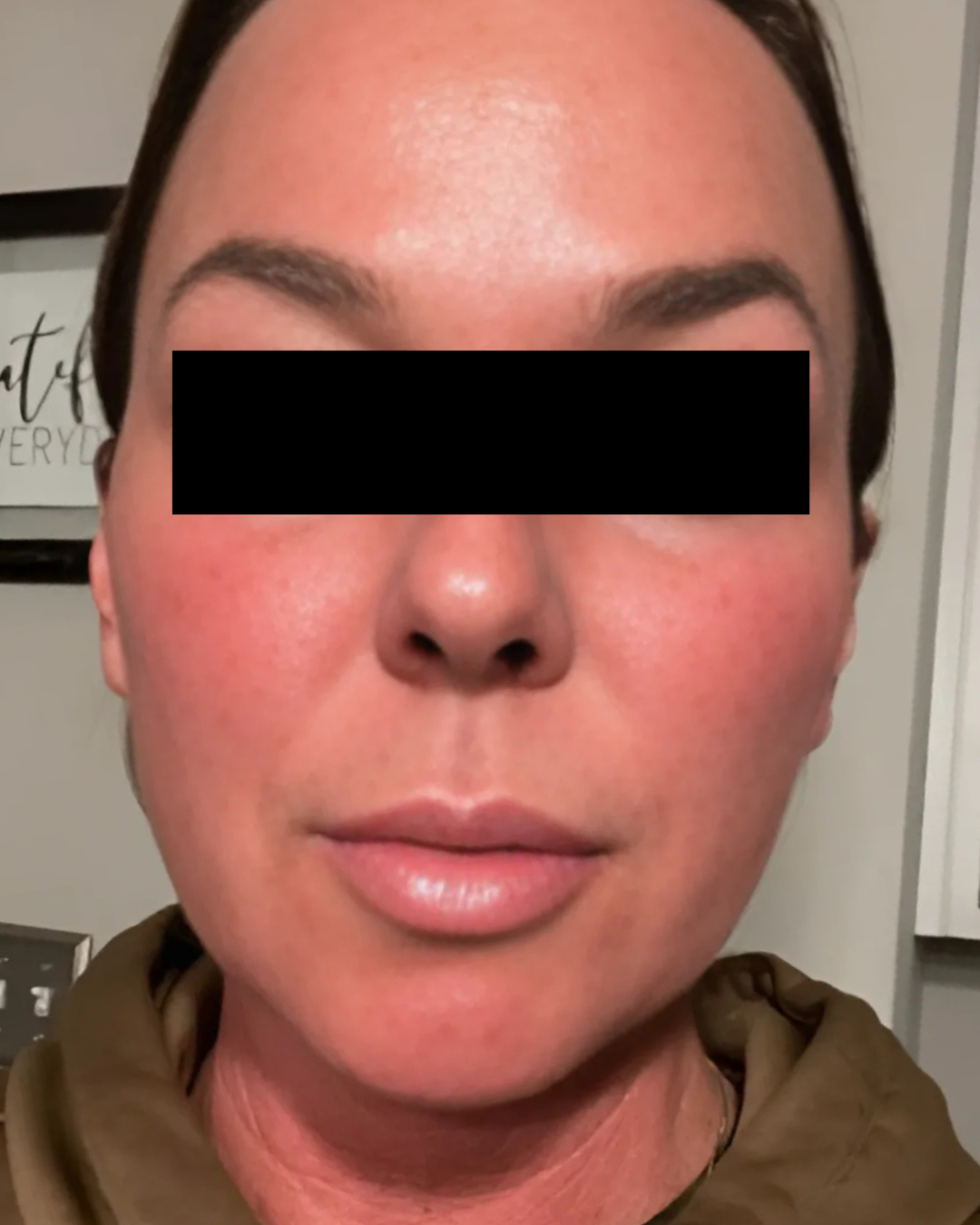Microneedling Post 6 Hours